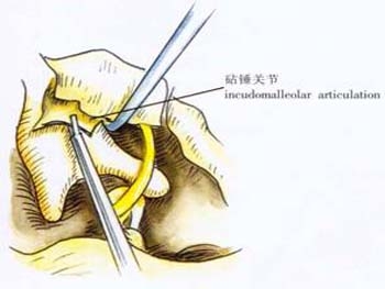 多发性硬化中医治疗方法