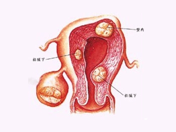 什么是肌肉瘤