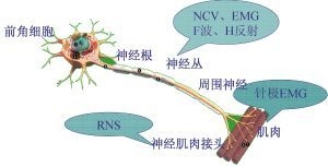 神经再造综合疗法帮助张先生恢复正常生活