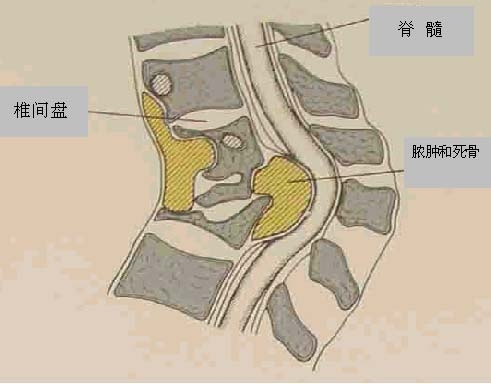 截瘫容易与哪些症状混淆