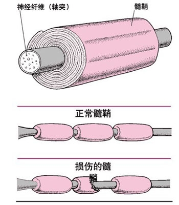 多发性硬化如何预防