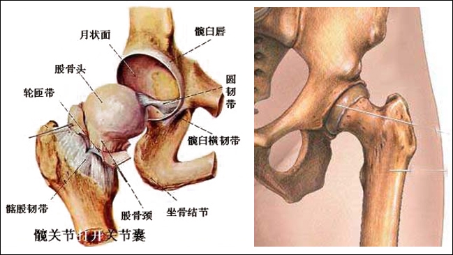 股骨头坏死的并发症有哪些
