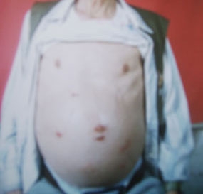 肝腹水是由什么原因引起的