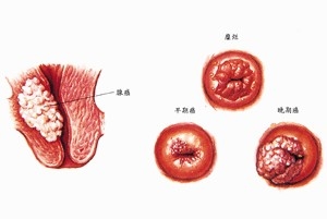 子宫癌如何治疗