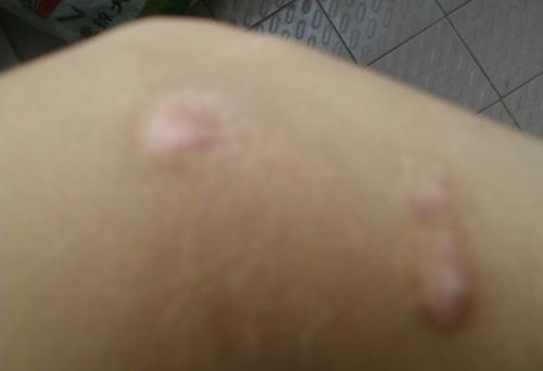 皮肤癌有哪些症状
