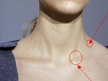 颈部淋巴癌早期症状-995健康网