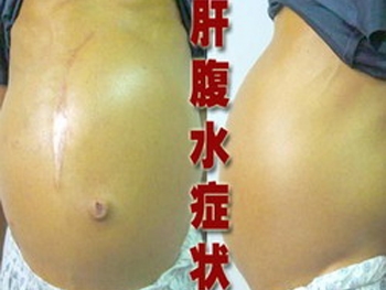 出现了肝腹水怎么办