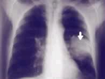 肺癌早期会转移吗