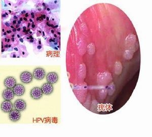 人乳头状瘤病毒感染与宫颈癌的关系