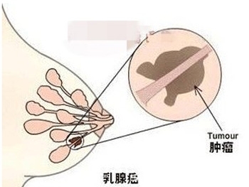 乳腺癌能活多久