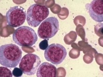 急性单核细胞白血病能治好吗