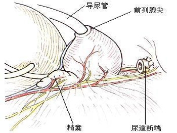 前列腺手术后尿失禁