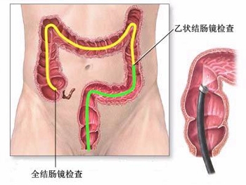 如何检查大肠癌