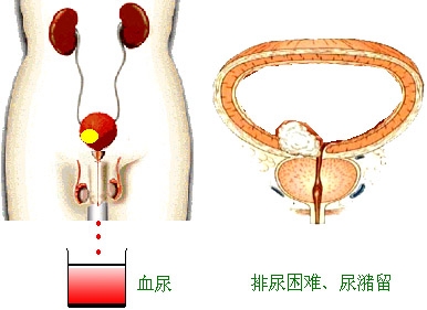 膀胱癌症状的早期表现