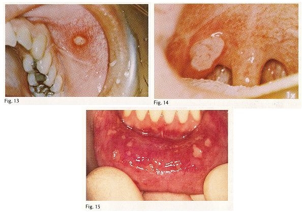 口腔炎的具体症状是什么?