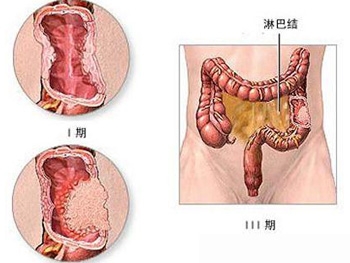 肠道良性肿瘤有什么症状