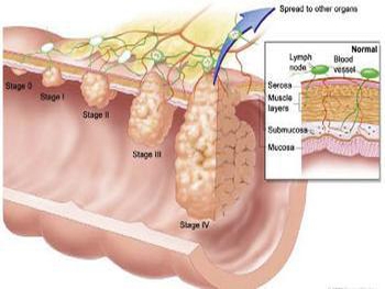 膀胱癌转移结肠的症状