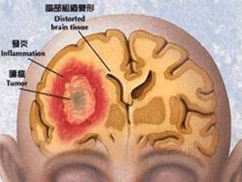 颅内肿瘤患者注意事项