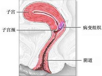 宫颈囊肿不手术行吗