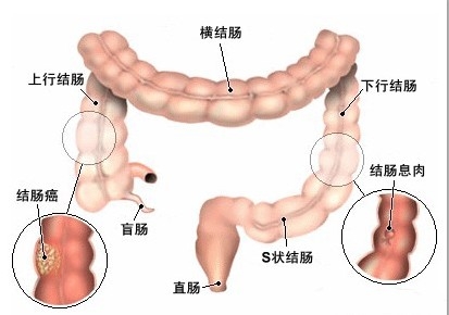 肠癌晚期症状有哪些