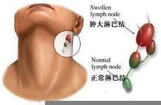 淋巴结肿大和淋巴癌怎么分辨