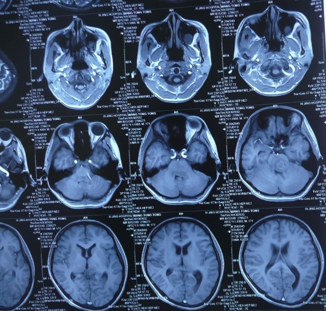 中医治疗脑膜瘤方法