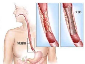 食道癌手术治疗成活率