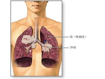 肺癌的危险信号