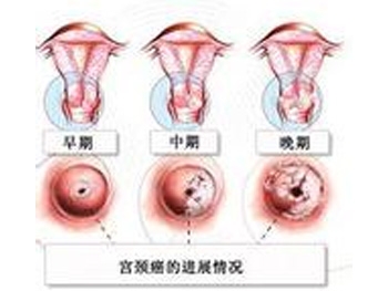 宫颈癌并发症护理及预防