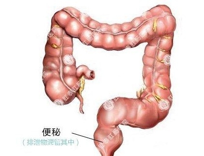 常见症状 竟是肠癌报警信号