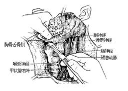 甲状腺癌相关常识