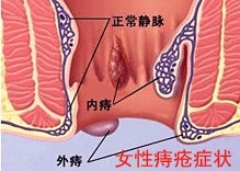 后“股”之忧别把直肠癌当痔疮