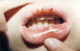 口腔溃疡能导致口腔癌吗
