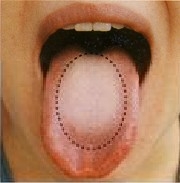 舌癌晚期症状有哪些