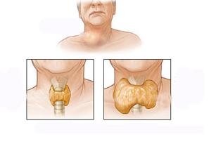 甲状腺癌应该如何预防