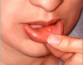 口腔溃疡不愈者要警惕舌癌