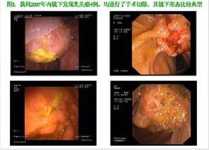 专家为您全面解析胆管癌