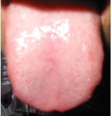 舌癌病理常识