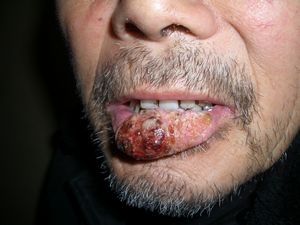 口腔癌会在嘴唇上吗