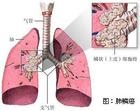 鳞癌是肺癌的常见类型之一