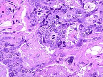 鳞状细胞癌的检查与分期