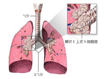 肺鳞癌的临床症状你知道多少