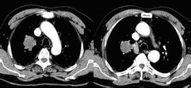 肺鳞癌和肺腺癌的联系和区别