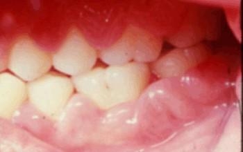 什么是牙龈鳞状癌细胞