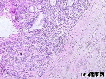 甲状腺癌的病因病理解析