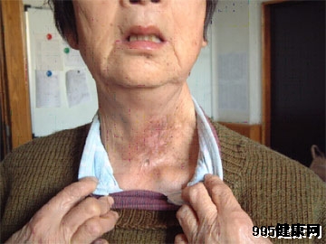 甲状腺癌容易与哪些疾病混淆