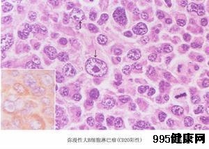 黑色素瘤的常见类型有哪些