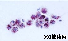 基底细胞样鳞状细胞癌