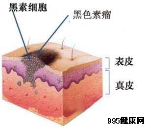 为什么会得黑色素瘤?