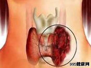 甲状腺癌早期症状具体表现